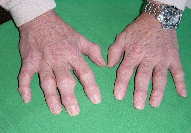 Osteoartróza prstů