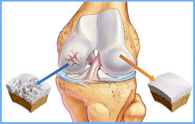 Normální kolenní kloub a postižený artrózou