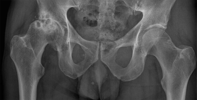 Deformující artróza kyčelního kloubu na rentgenu