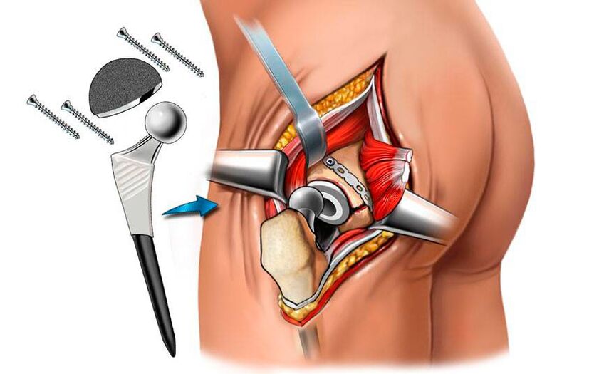 Instalace endoprotézy - chirurgické řešení problému koxartrózy