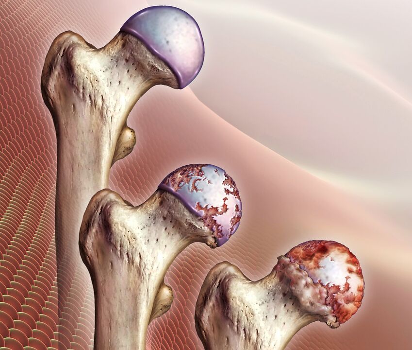 Rozvoj artrózy kyčelního kloubu
