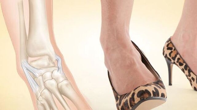 nošení bot s podpatky jako příčina artrózy kotníku